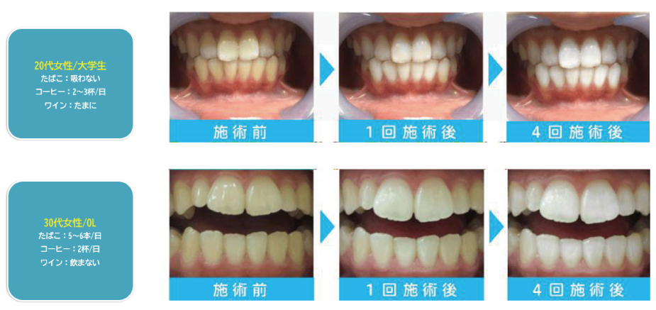 ホワイトニング効果